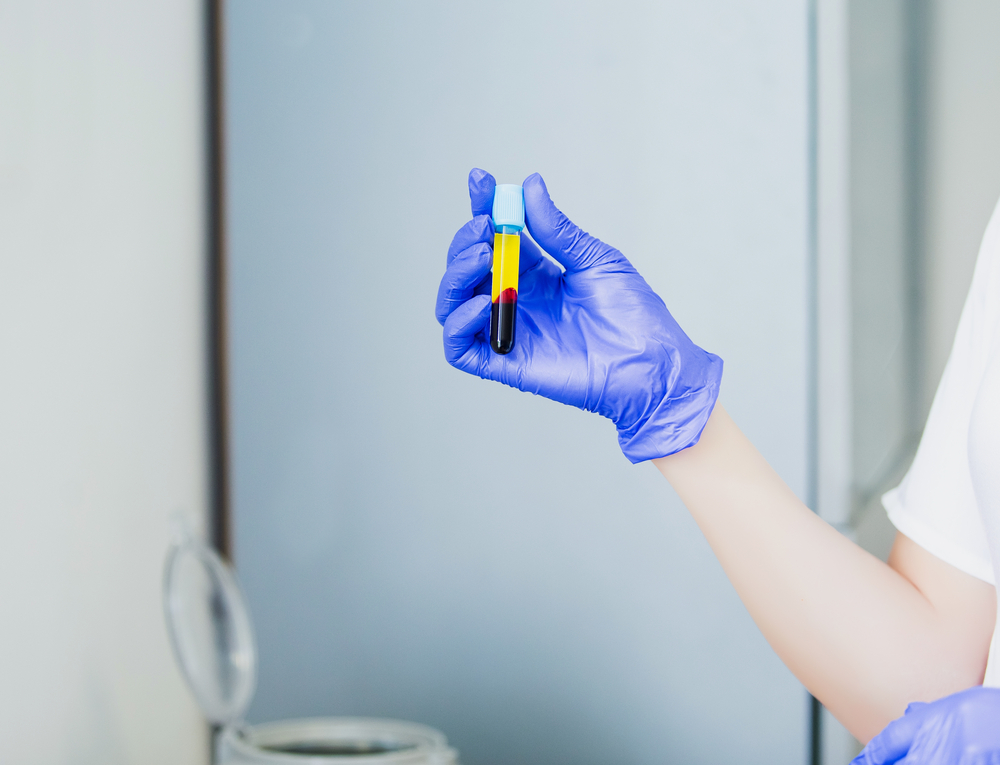 platelet-rich-plasma